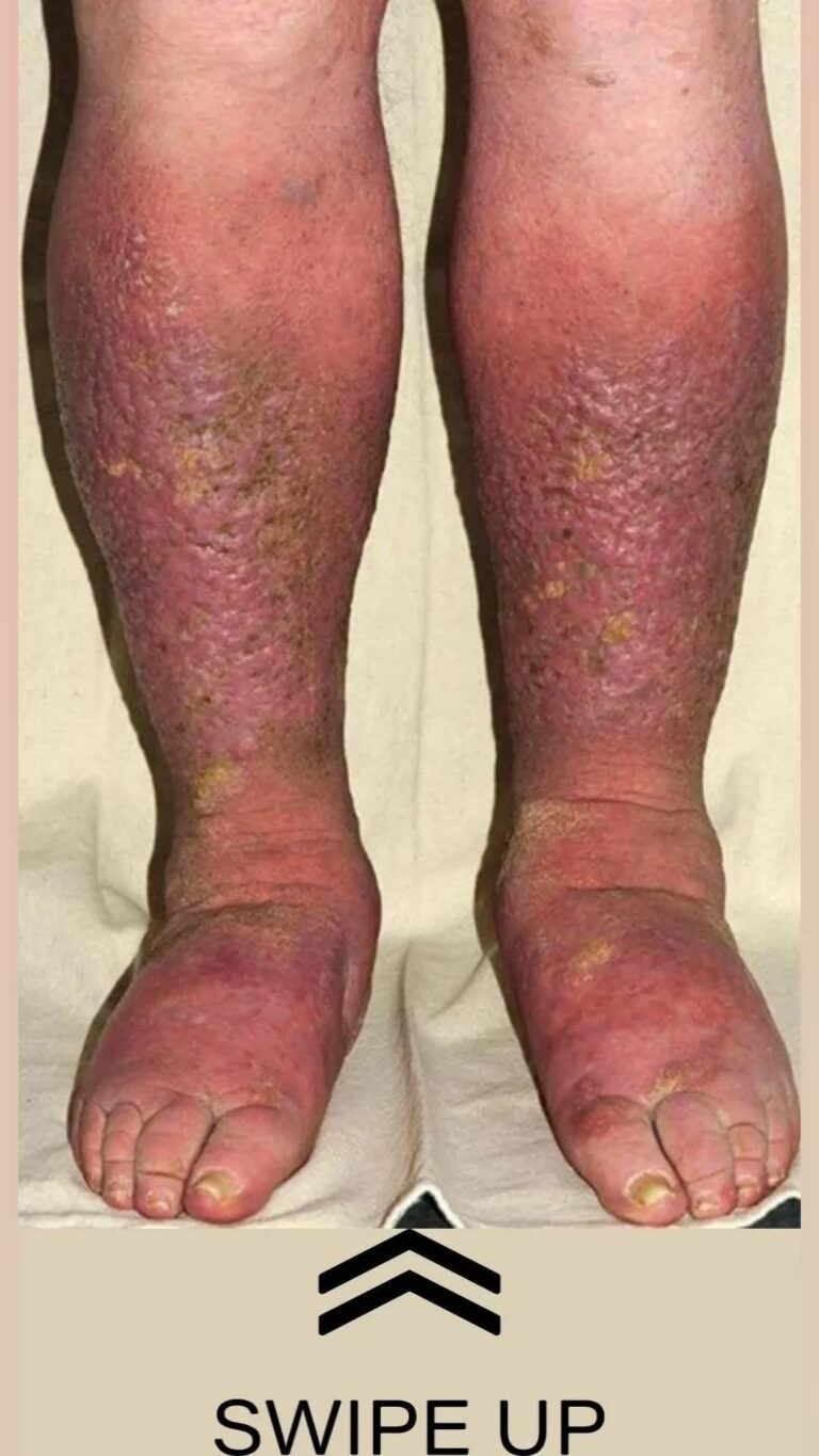 Shocking Ways Your Feet Reveal Heart Trouble