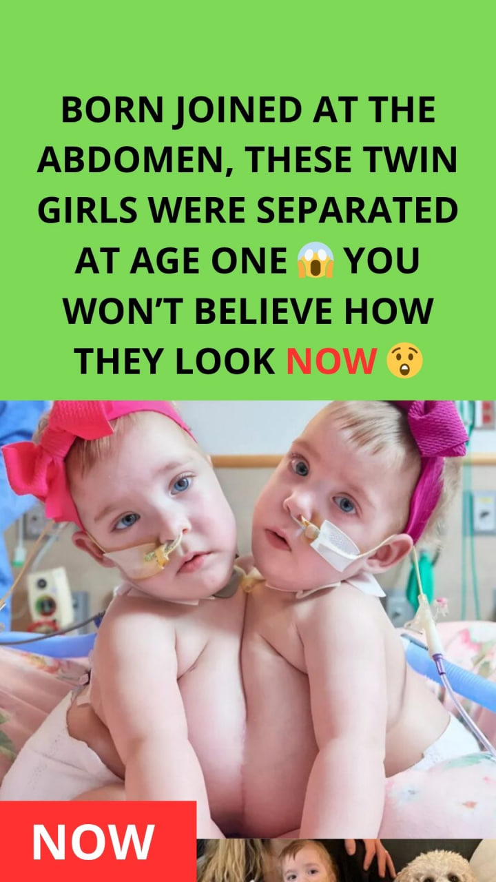 The sisters were born joined at the abdomen, but a year later doctors separated them: this is what the sisters look like today
