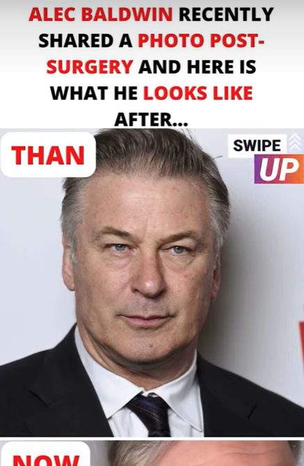 Alec Baldwin Recently Shared a Photo Post-Surgery and Here is What He Looks Like After…