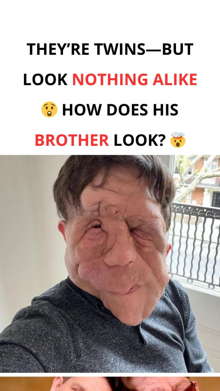 “People don’t realize we’re twins”: Disease affected the brothers’ appearance differently