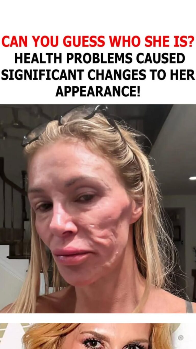 Can You Guess Who She Is?: Health Problems Caused Significant Changes to Her Appearance!