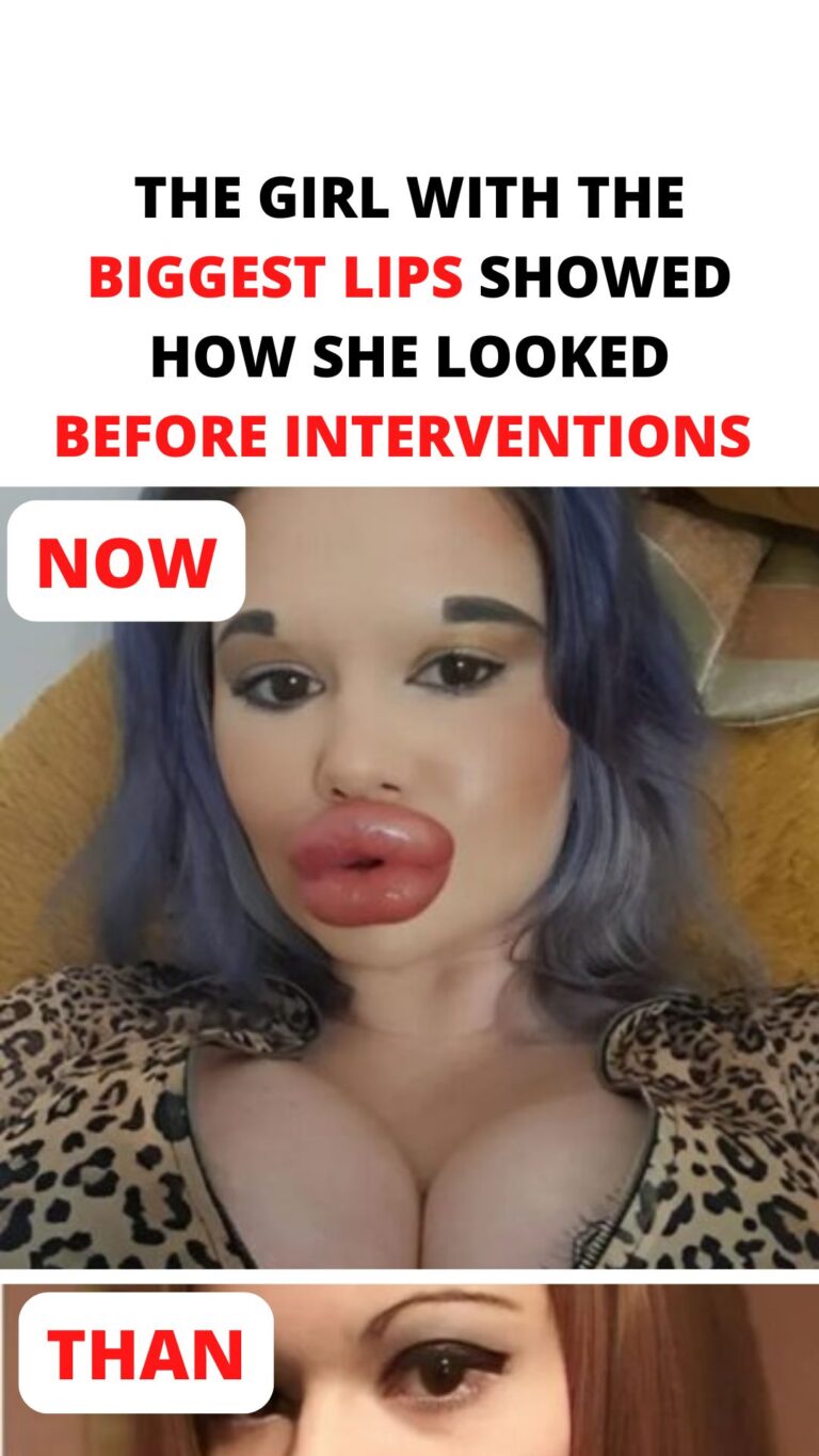 Before Duck Lips! Here Is What The Girl With The Immense Lips Looked Like Before Plastic Operation