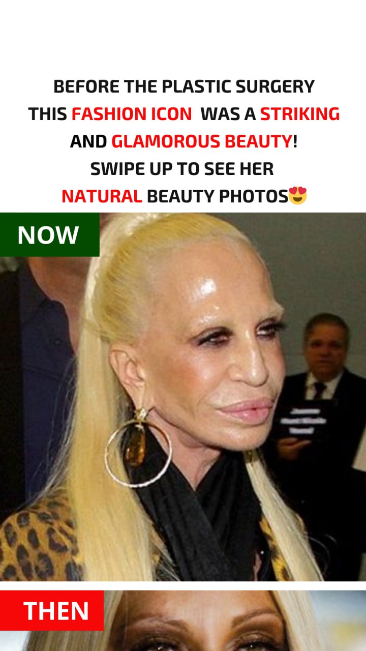 Donatella Versace Before and After Plastic Surgery